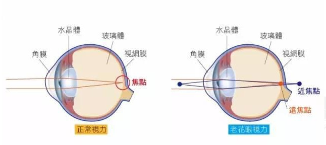 白內障和老花眼區(qū)別，老花眼發(fā)病率正呈現(xiàn)年輕化趨勢